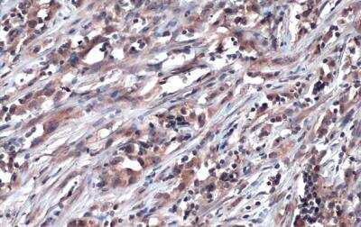 Immunohistochemistry-Paraffin: Glyoxalase I Antibody [NBP1-31466] - Human ovarian cancer. Glyoxalase I stained by Glyoxalase I antibody [N1C3] diluted at 1:500. Antigen Retrieval: Citrate buffer, pH 6.0, 15 min.