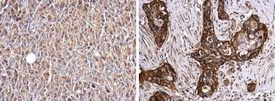 <b>Independent Antibodies Validation. </b>Immunohistochemistry-Paraffin: Glypican 1 Antibody [NBP3-13127] - Human pancreas, normal (left) and cancer (right). Glypican 1 antibody (NBP3-13127) diluted at 1:250. Antigen Retrieval: Citrate buffer, pH 6.0, 15 min