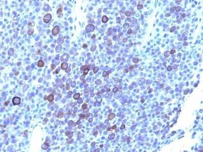 Immunohistochemistry-Paraffin: Glypican 3 Antibody (1G12 + GPC3/863) - Azide and BSA Free [NBP2-47763] - Human Melanoma stained with Glypican-3 Monoclonal Antibody (1G12 + GPC3/863)