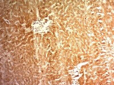 Immunohistochemistry-Paraffin: Glypican 3 Antibody (1G12) - Azide and BSA Free [NBP2-47760] - Human Hepatocellular Carcinoma stained with Glypican-3 Monoclonal Antibody (1G12)