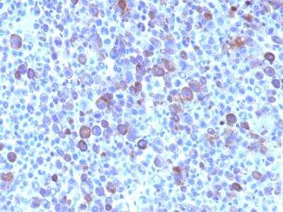 Immunohistochemistry-Paraffin: Glypican 3 Antibody (SPM595) - IHC-Prediluted [NBP2-48397] - Human Hepatocellular Carcinoma stained with Glypican-3 Mouse Monoclonal Antibody (SPM595).