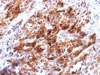 Immunohistochemistry-Paraffin: Glypican 3 Antibody (rGPC3/863) - Azide and BSA Free [NBP2-54304] - Formalin-fixed, paraffin-embedded human Hepatocellular Carcinoma stained with Glypican-3 Recombinant Mouse Monoclonal Antibody (rGPC3/863).