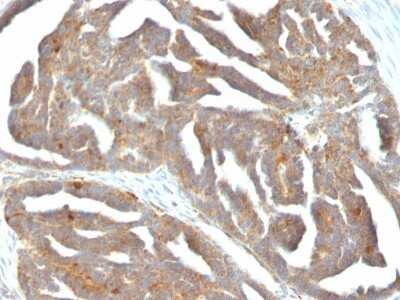 Immunohistochemistry-Paraffin: GnRHR Antibody (F1G4 (same as GNRH03)) - IHC-Prediluted [NBP2-48419] - Human Ovarian Carcinoma stained with GnRH-Receptor Monoclonal Antibody (F1G4).