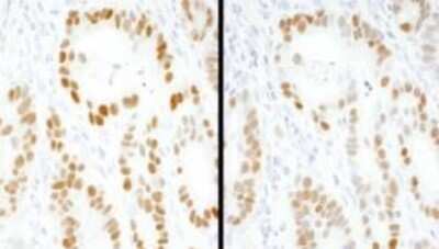 Immunohistochemistry-Paraffin: Goat anti-Mouse IgG (H+L) Secondary Antibody [HRP] [NB7539] - FFPE serial sections of human stomach carcinoma.  Primary Antibody: Mouse anti-p53 (Clone DO-1) used at a dilution of 1:100. Secondary Antibody: Goat anti-Mouse IgG (H+L) Secondary Antibody [HRP] Conjugated used at a dilution of 1:200 (5ug/ml). Detection: DAB