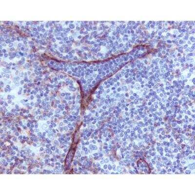 Immunohistochemistry: Goat anti-Mouse IgG ImmPRESS(TM) Secondary Antibody [HRP Polymer] [MP-7452-NB] - Lymphoma: Lymphatic endothelium stained using mouse monoclonal antibody against M2A antigen (clone D2-40), ImmPress anti-mouse Ig reagent, and Vector NovaRED peroxidase substrate ( red). Hematoxylin QS counterstain (blue)