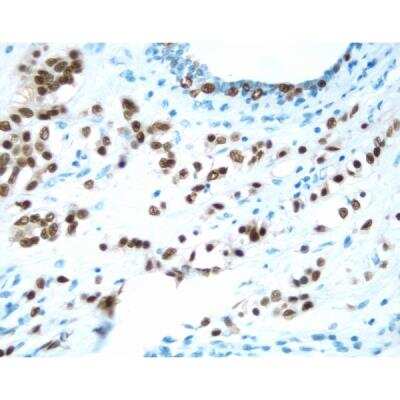 Immunohistochemistry: Goat anti-Mouse IgG ImmPRESS(TM) Secondary Antibody [HRP Polymer] [MP-7452-NB] - Breast: Estrogen Receptor (m), ImmPRESS Anti-Mouse Ig Kit, DAB Substrate Kit (brown). Hematoxylin counterstain (blue).