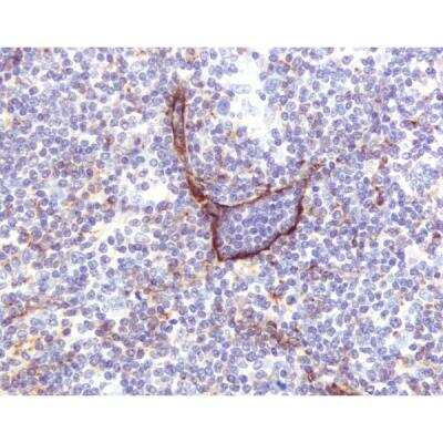 Immunohistochemistry: Goat anti-Mouse IgG ImmPRESS(TM) Secondary Antibody [HRP Polymer] [MP-7452-NB] - Lymphoma: Lymphatic endothelium stained using mouse monoclonal antibody against M2A antigen (clone D2-40), ImmPress anti-mouse Ig reagent, and Vector NovaRED peroxidase substrate (red). Hematoxylin QS counterstain (blue)