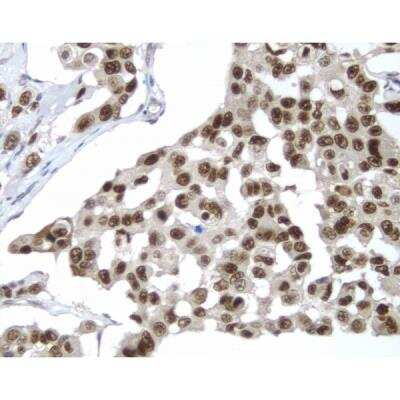 Immunohistochemistry: Goat anti-Rabbit IgG ImmPRESS(TM) Secondary Antibody [HRP Polymer] [MP-7451-NB] - Breast: p53 (rp), ImmPRESS Anti-Rabbit Ig Kit, DAB Substrate Kit (brown). Hematoxylin QS counterstain (blue)