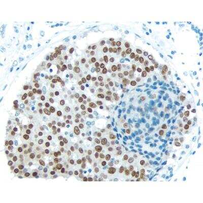 Immunohistochemistry: Goat anti-Rabbit IgG ImmPRESS(TM) Secondary Antibody [HRP Polymer] [MP-7451-NB] - Breast Carcinoma: Estrogen receptor (rm), ImmPRESS Anti-Rabbit Ig Kit, DAB (brown) substrate. Hematoxylin QS (blue) counterstain.