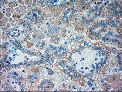 Immunohistochemistry: Goosecoid Antibody (OTI1D7) - Azide and BSA Free [NBP2-72409] - Staining of paraffin-embedded Carcinoma of Human kidney tissue using anti-GSC mouse monoclonal antibody.