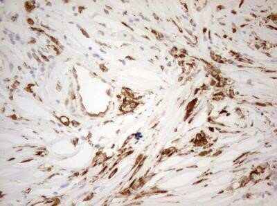 Immunohistochemistry: Granulin Antibody (OTI3H6) - Azide and BSA Free [NBP2-70847] - Staining of paraffin-embedded Adenocarcinoma of Human breast tissue using anti-GRN mouse monoclonal antibody.