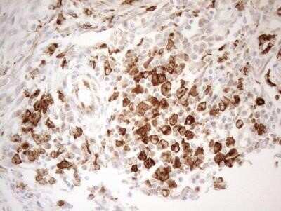 Immunohistochemistry: Granulin Antibody (OTI3H6) - Azide and BSA Free [NBP2-70847] - Staining of paraffin-embedded Adenocarcinoma of Human colon tissue using anti-GRN mouse monoclonal antibody.