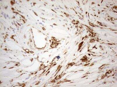 Immunohistochemistry-Paraffin: Granulin Antibody (OTI3H6) [NBP2-45915] - Staining of paraffin-embedded Adenocarcinoma of Human breast tissue using anti-GRN mouse monoclonal antibody. 