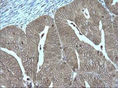 Immunohistochemistry: Granzyme B Antibody (OTI4E4) - Azide and BSA Free [NBP2-70870] - Analysis of Adenocarcinoma of Human endometrium tissue. (Heat-induced epitope retrieval by 10mM citric buffer, pH6.0, 120C for 3min)