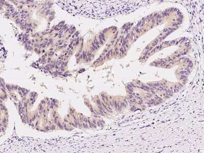 Immunohistochemistry-Paraffin: Growth Hormone 2 Antibody [NBP2-99112] - Immunochemical staining of human Growth Hormone 2 in human colon carcinoma with rabbit polyclonal antibody at 1:200 dilution, formalin-fixed paraffin embedded sections.