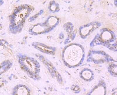 Immunohistochemistry-Paraffin: Growth Hormone Antibody (JM108-09) [NBP2-66893] - Analysis of paraffin-embedded human breast cancer tissue using anti-Growth Hormone antibody. Counter stained with hematoxylin.
