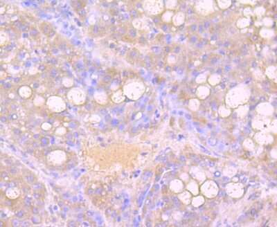 Immunohistochemistry-Paraffin: Growth Hormone Antibody (JM108-09) [NBP2-66893] - Analysis of paraffin-embedded human liver cancer tissue using anti-Growth Hormone antibody. Counter stained with hematoxylin.
