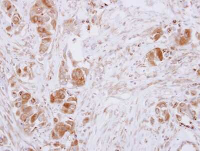 <b>Genetic Strategies Validation. </b>Immunohistochemistry-Paraffin: Guanine deaminase Antibody [NBP2-16769] - Immunohistochemical analysis of paraffin-embedded Breast ca, using antibody at 1:500 dilution.