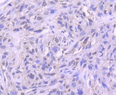 Immunohistochemistry-Paraffin: H1F0 Antibody (SD206-04) [NBP2-67752] - Analysis of paraffin-embedded human breast carcinoma tissue using anti-Histone H1.0 antibody. Counter stained with hematoxylin.
