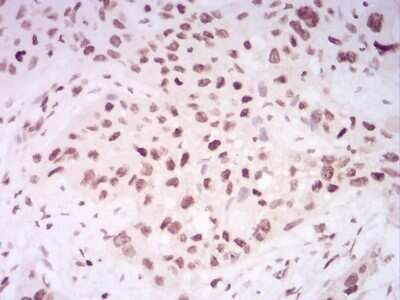 Immunohistochemistry: H4/n Antibody (3E7D9) [NBP2-52487] - Analysis of paraffin-embedded esophageal cancer tissues using HIST2H4A(20Me) mouse mAb with DAB staining.