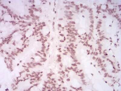 Immunohistochemistry: H4/n Antibody (3E7D9) [NBP2-52487] - Analysis of paraffin-embedded colon cancer tissues using HIST2H4A(20Me) mouse mAb with DAB staining.