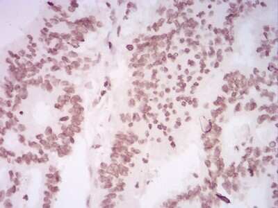 Immunohistochemistry: H4/n Antibody (3E7H2) [NBP2-52486] - Analysis of paraffin-embedded rectum cancer tissues using HIST2H4A(20Me) mouse mAb with DAB staining.