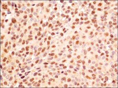 Immunohistochemistry: HA95/AKAP8L Antibody [NBP1-79140] - IHC staining of HA95/AKAP8L in human ovarian cancer using DAB with hematoxylin counterstain.