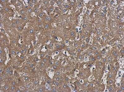 Immunohistochemistry-Paraffin: HARS Antibody [NBP2-16781] - Immunohistochemical analysis of paraffin-embedded Hepatoma, using antibody at 1:500 dilution.