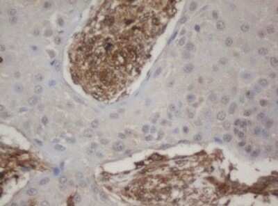 Immunohistochemistry: HBS1L Antibody (OTI1C1) - Azide and BSA Free [NBP2-71628] - Analysis of Carcinoma of Human lung tissue.