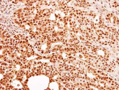 Immunohistochemistry-Paraffin: HCA59 Antibody [NBP1-32518] - Paraffin-embedded NCI-N87 xenograft, using antibody at 1:500 dilution.
