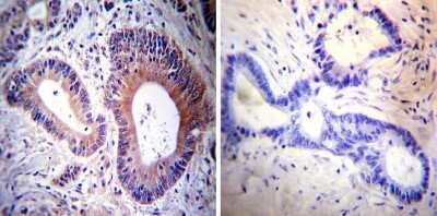 Immunohistochemistry-Paraffin: HCN3 Antibody (TLL6C5) [NB100-74438] - Both normal and cancer biopsies of deparaffinized Human colon carcinoma tissues.