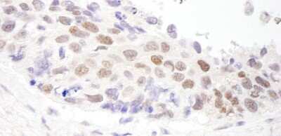 Immunohistochemistry-Paraffin: HDAC3 Antibody [NB100-79798] - Sample: FFPE section of human ovarian carcinoma. Antibody: Affinity purified rabbit anti-HDAC3 used at a dilution of 1:200 (1ug/ml). Detection: DAB