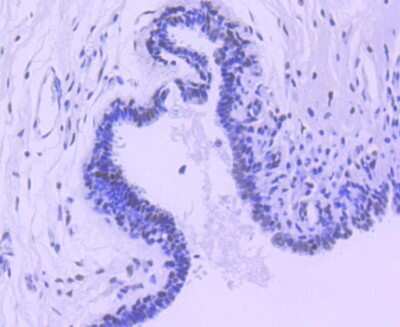 Immunohistochemistry-Paraffin: HDAC3 Antibody (SC55-02) [NBP2-67592] - Analysis of paraffin-embedded human breast carcinoma tissue using anti-HDAC3 antibody. Counter stained with hematoxylin.