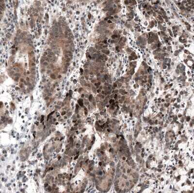 Immunohistochemistry-Paraffin: HDAC5 Antibody (CL8121) [NBP2-88913] - Staining of human stomach cancer shows moderate to strong cytoplasmic and nuclear positivity.