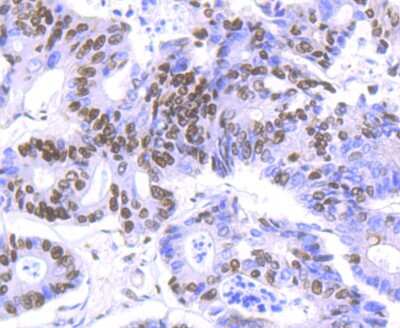Immunohistochemistry-Paraffin: HDAC9 Antibody (JU30-44) [NBP2-75519] - Analysis of paraffin-embedded human colon cancer tissue using anti-HDAC9 antibody. Counter stained with hematoxylin.