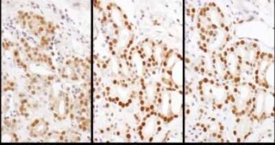 Immunohistochemistry: HDGF Antibody [NBP1-71925] - Samples: FFPE serial sections of human breast carcinoma. Antibody: Affinity purified rabbit anti- HDGF used at a dilution of 1:1,000 (1ug/ml) or 1:200 (1ug/ml). Detection: DAB. Counterstain: Hematoxylin (blue).