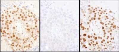 <b>Independent Antibodies Validation and Biological Strategies Validation.</b>Immunohistochemistry: HDGF Antibody [NBP1-71925] - Samples: FFPE serial sections of mouse renal cell carcinoma. Antibody: Affinity purified rabbit anti- HDGF used at a dilution of 1:1,000 (1ug/ml) or 1:200 (1ug/ml). Detection: DAB. Counterstain: Hematoxylin (blue).