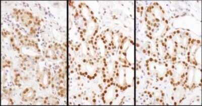 Immunohistochemistry-Paraffin: HDGF Antibody [NBP1-71924] - Serial sections of human breast carcinoma. Antibody: Affinity purified rabbit anti- HDGF used at a dilution of 1:1,000 (1ug/ml) or 1:200 (1ug/ml). Detection: DAB. Counterstain: Hematoxylin (blue).