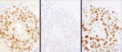 Immunohistochemistry-Paraffin: HDGF Antibody [NBP1-71926] - Immunohistochemistry-Paraffin: HDGF Antibody [NBP1-71926] - FFPE serial sections of mouse renal cell carcinoma. Antibody: Affinity purified rabbit anti-HDGF left image, middle image and right image used at a dilution of 1: 1,000 (1ug/ml) or 1:200 (1ug/ml). Detection: DAB. Counterstain: Hematoxylin (blue).