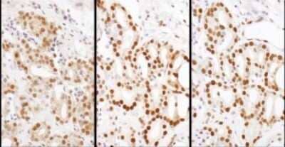 <b>Independent Antibodies Validation and Biological Strategies Validation.</b>Immunohistochemistry-Paraffin: HDGF Antibody [NBP1-71926] - Samples: FFPE serial sections of human breast carcinoma. Antibody: Affinity purified rabbit anti- HDGF used at a dilution of 1:1,000 (1ug/ml) or 1:200 (1ug/ml). Detection: DAB. Counterstain: Hematoxylin (blue).