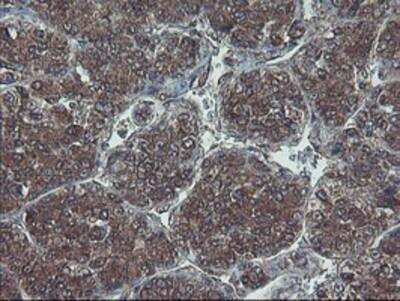 Immunohistochemistry-Paraffin: HDHD1A Antibody (7A2) [NBP2-00487] - Staining of paraffin-embedded Carcinoma of Human liver tissue using anti-HDHD1A mouse monoclonal antibody.