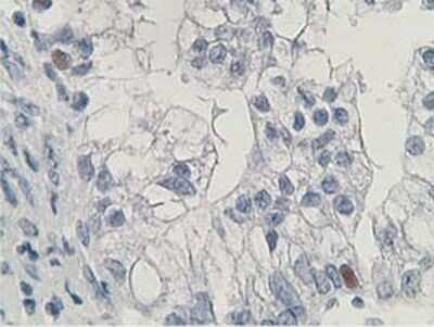 Immunohistochemistry: HDHD2 Antibody (OTI4G3) - Azide and BSA Free [NBP2-72259] - Staining of paraffin-embedded Adenocarcinoma of Human ovary tissue using anti-HDHD2 mouse monoclonal antibody.