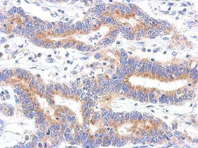 Immunohistochemistry-Paraffin: HDHD3 Antibody [NBP2-16798] - Immunohistochemical analysis of paraffin-embedded colon ca, using antibody at 1:500 dilution.
