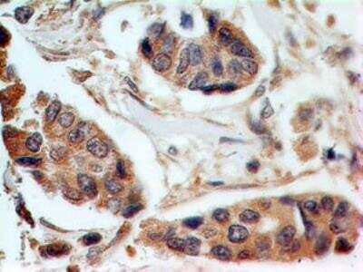 Immunohistochemistry-Paraffin: HE4/WFDC2 Antibody [NBP2-27294] -  Formalin-fixed, paraffin-embedded breast cancer (IDC) stained with HE4 antibody (5 ug/ml), peroxidase-conjugate and DAB chromogen. Note invasive ductal carcinoma staining. Tissue microarray was used for this test.