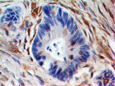 Immunohistochemistry-Paraffin: HE4/WFDC2 Antibody [NBP2-27294] -  Formalin-fixed, paraffin-embedded ovarian cancer stained with HE4 antibody (5 ug/ml), peroxidase-conjugate and DAB chromogen. Note stromal staining. s tissue microarray was used for this test.