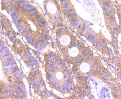 Immunohistochemistry-Paraffin: HECTD4 Antibody (A2-F5-F10) [NBP2-75411] - Analysis of paraffin-embedded human colon cancer tissue using anti-C12orf51 antibody. Counter stained with hematoxylin.