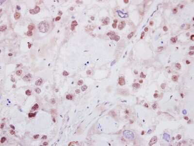 Immunohistochemistry-Paraffin: Helios Antibody [NBP2-16802] - Human ovarian cancer, using HELIOS antibody at 1:250 dilution. Antigen Retrieval: Trilogy™ (EDTA based, pH 8.0) buffer, 15min