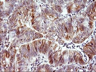 Immunohistochemistry: HERPUD1 Antibody (OTI1A2) - Azide and BSA Free [NBP2-71492] - Analysis of Carcinoma of Human pancreas tissue. (Heat-induced epitope retrieval by 1 mM EDTA in 10mM Tris, pH8.5, 120C for 3min)