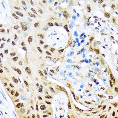 Immunohistochemistry-Paraffin: HES5 Antibody (4S4U7) [NBP3-16880] - Human lung cancer using HES5 Rabbit mAb (NBP3-16880) at dilution of 1:100 (40x lens).Perform microwave antigen retrieval with 10 mM Tris/EDTA buffer pH 9.0 before commencing with IHC staining protocol.