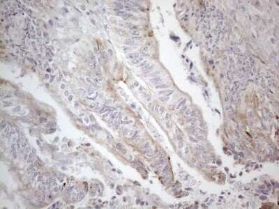 Immunohistochemistry: HGF Antibody (1D2) [NBP2-45972] - Analysis of Adenocarcinoma of Human colon tissue. (Heat-induced epitope retrieval by 1mM EDTA in 10mM Tris buffer (pH8.5) at 120C for 3 min)